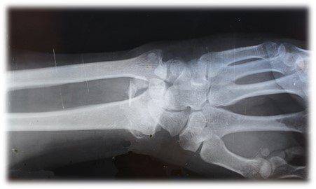 4% Impairment, $1.4m Payout for Wrist Injury